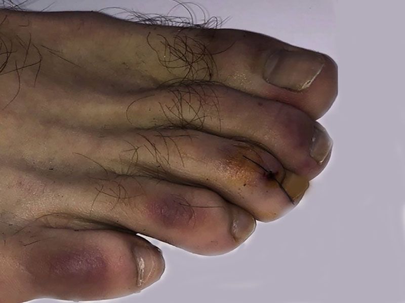 Expertos revelan nuevos posibles síntomas del COVID-19 1 covid toes54