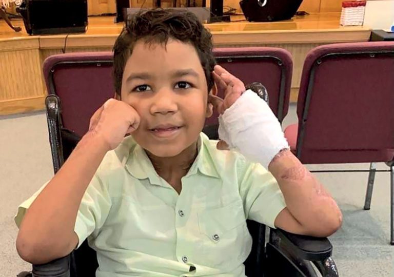 Triste historia de niño dominicano quemado