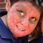 Alexander Salas Quiñones, el niño boliviano que sufrió graves quemaduras en un incendio en su casa en mayo del 2023